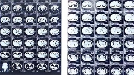 Medical X-Ray Film